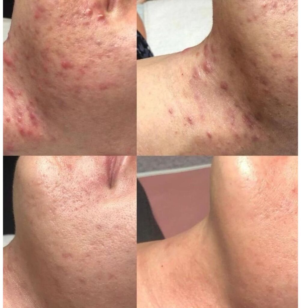 Resultado antes y después de un tratamiento con Dermapen