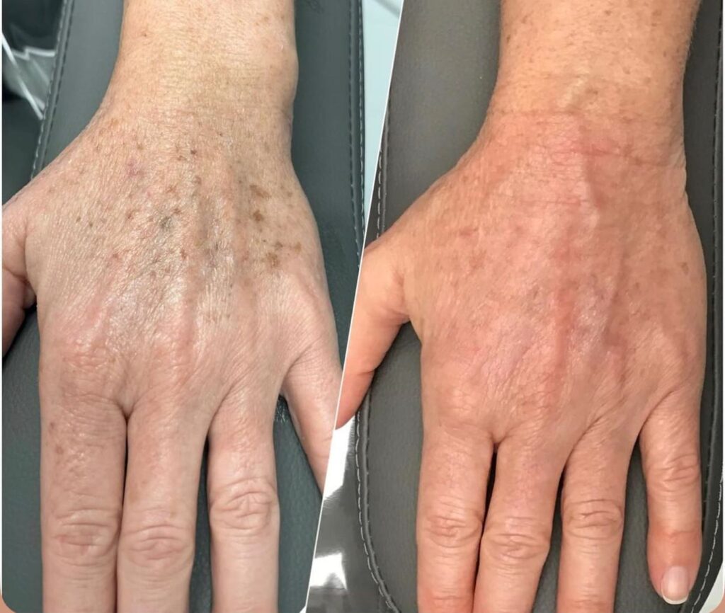 Resultado antes y después de un tratamiento con Dermapen