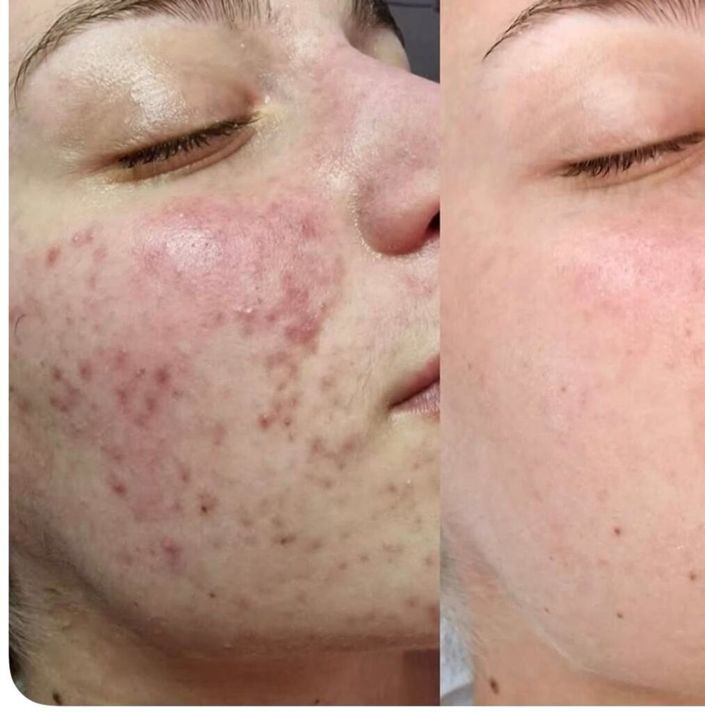 Resultado antes y después de un tratamiento con Dermapen