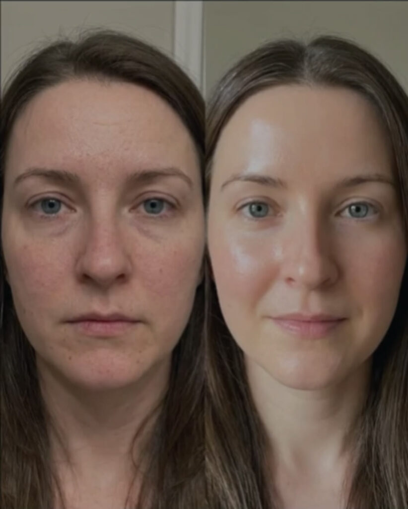 Resultado del tratamiento Dermapen tras 6 sesiones