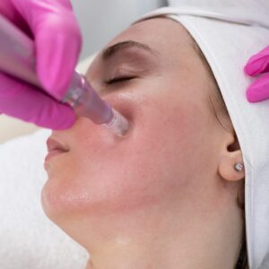 Tratamiento facial Dermapen en A Coruña